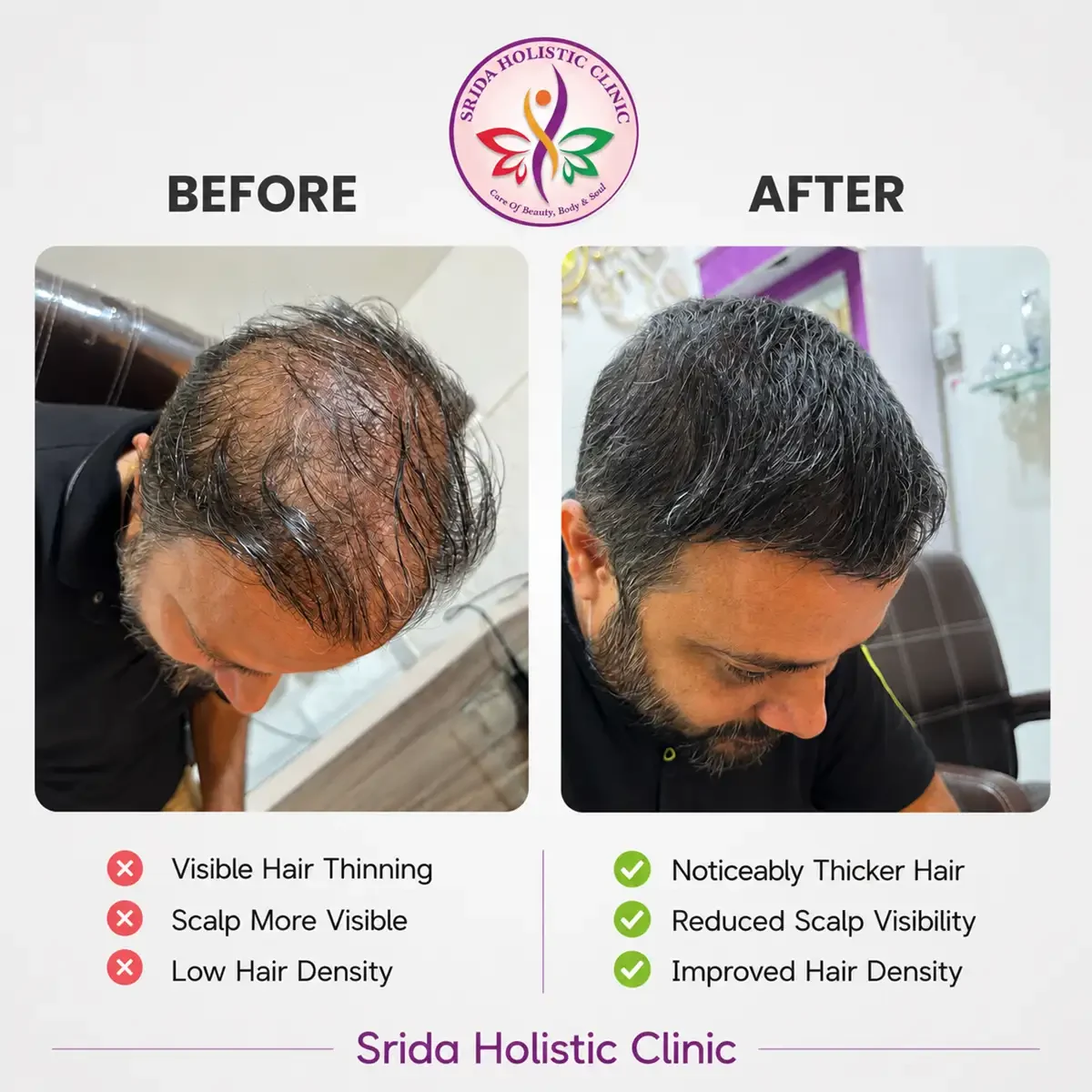 srida-clinic-hair-growth-before-after-results-1