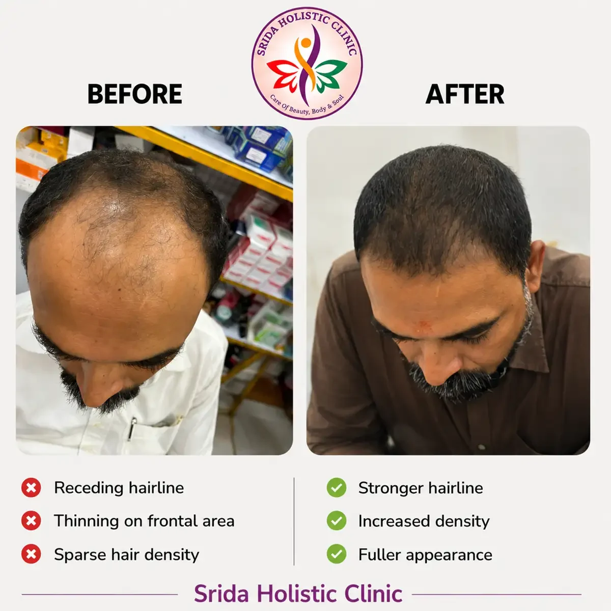 srida-clinic-hair-growth-before-after-results-10