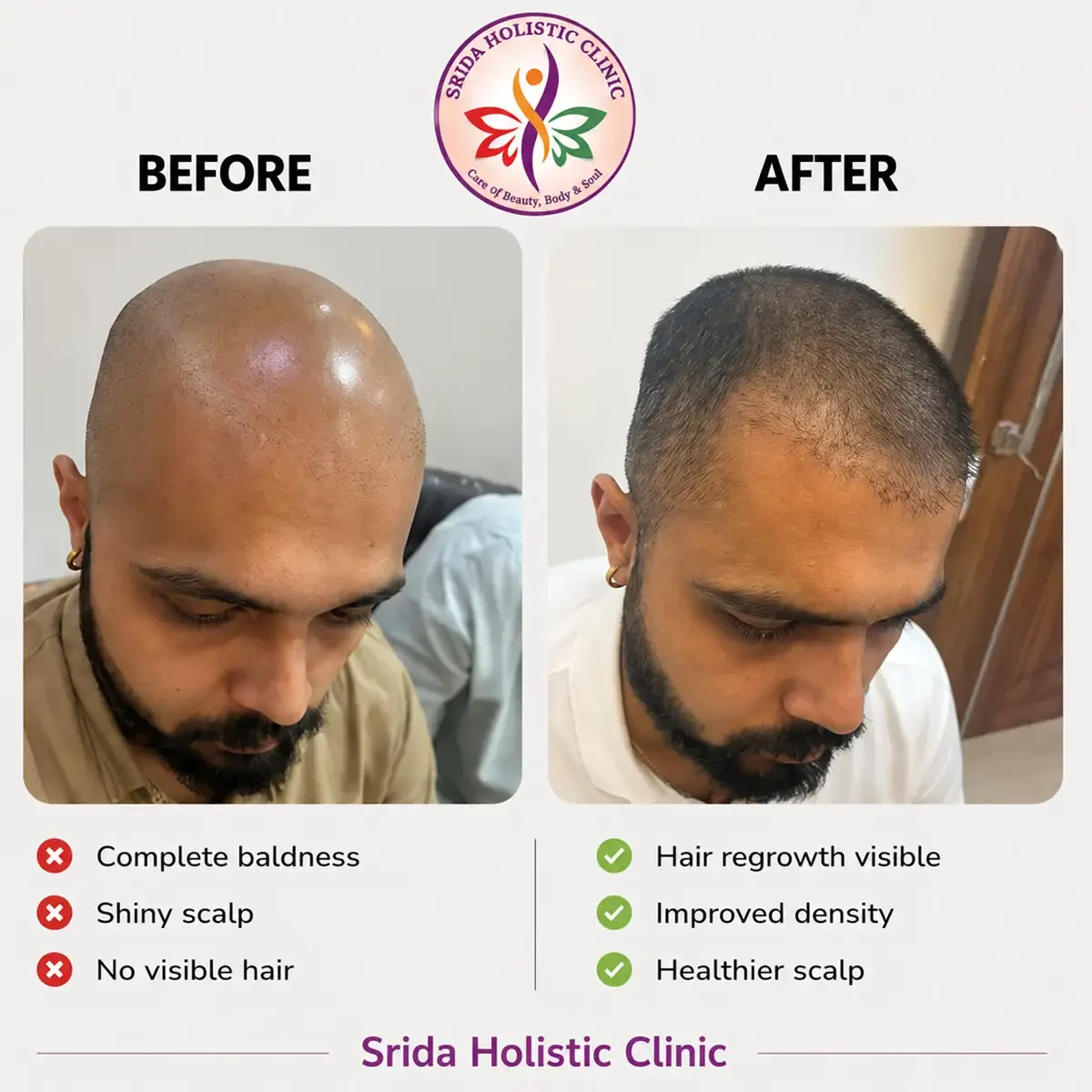 srida-clinic-hair-growth-before-after-results-11