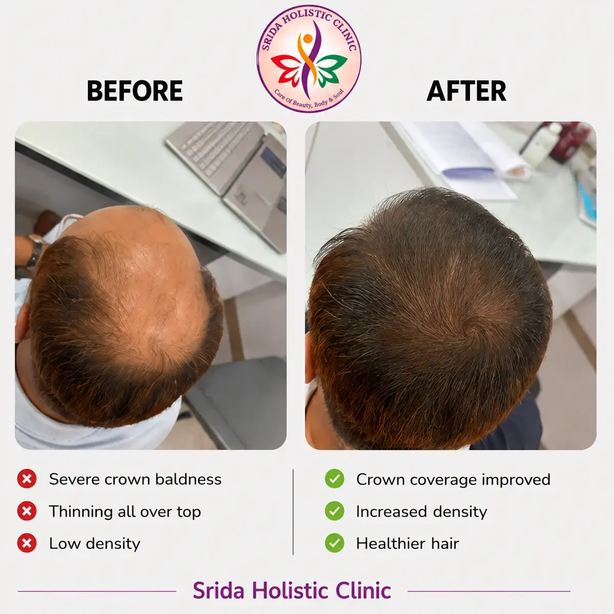 srida-clinic-hair-growth-before-after-results-13