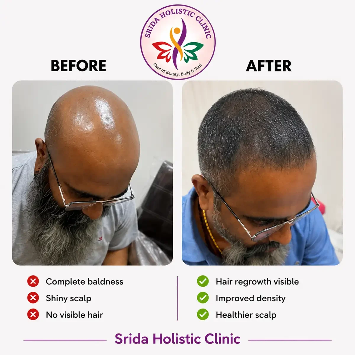 srida-clinic-hair-growth-before-after-results-15