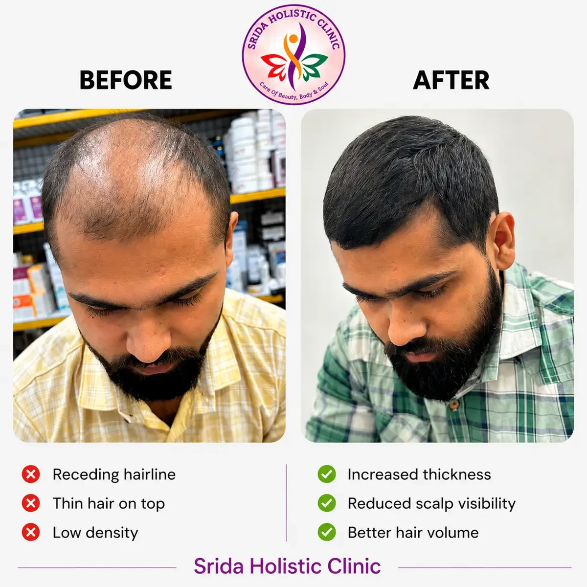 srida-clinic-hair-growth-before-after-results-16