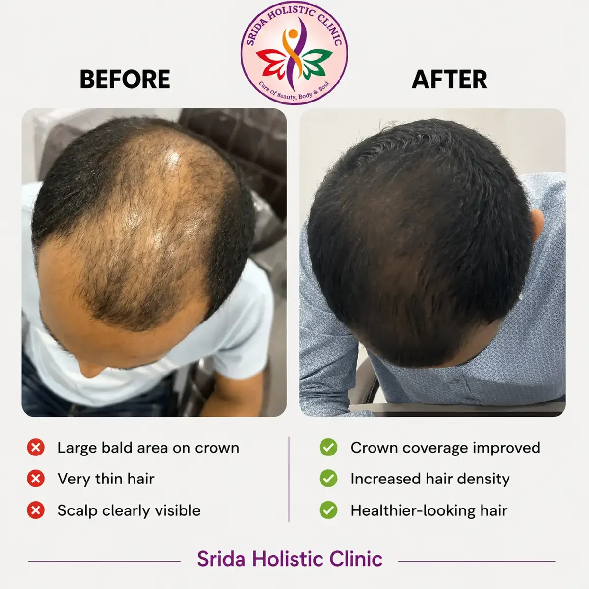 srida-clinic-hair-growth-before-after-results-17