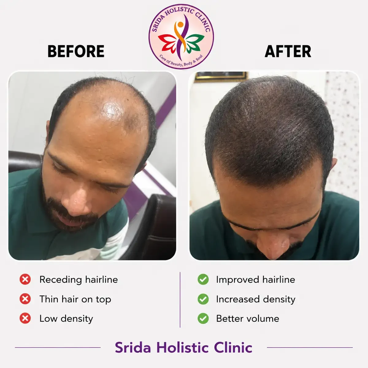 srida-clinic-hair-growth-before-after-results-18