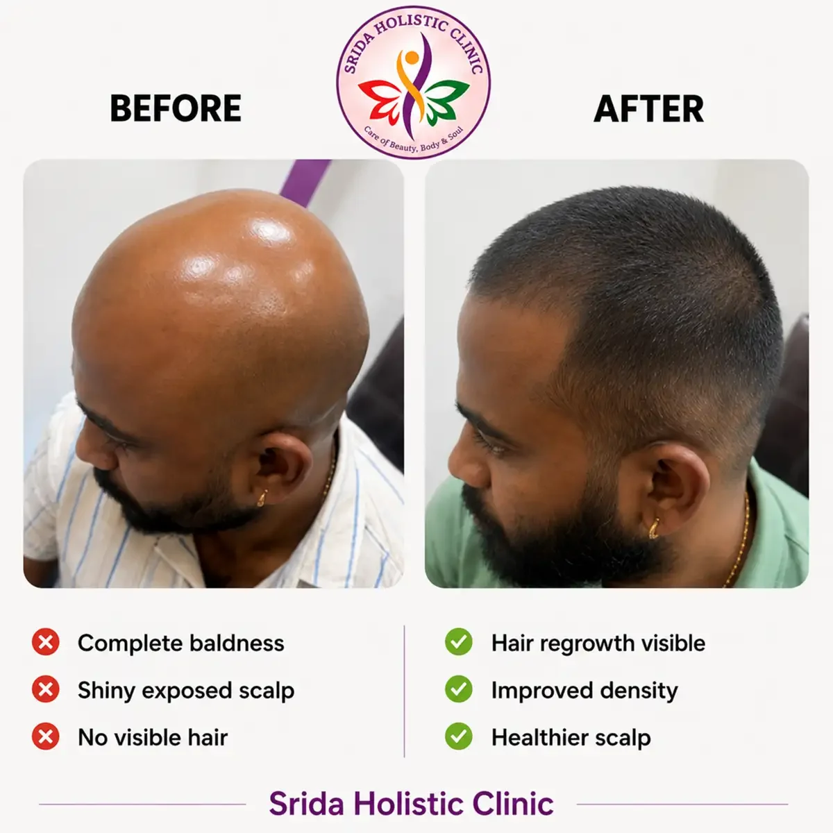 srida-clinic-hair-growth-before-after-results-19