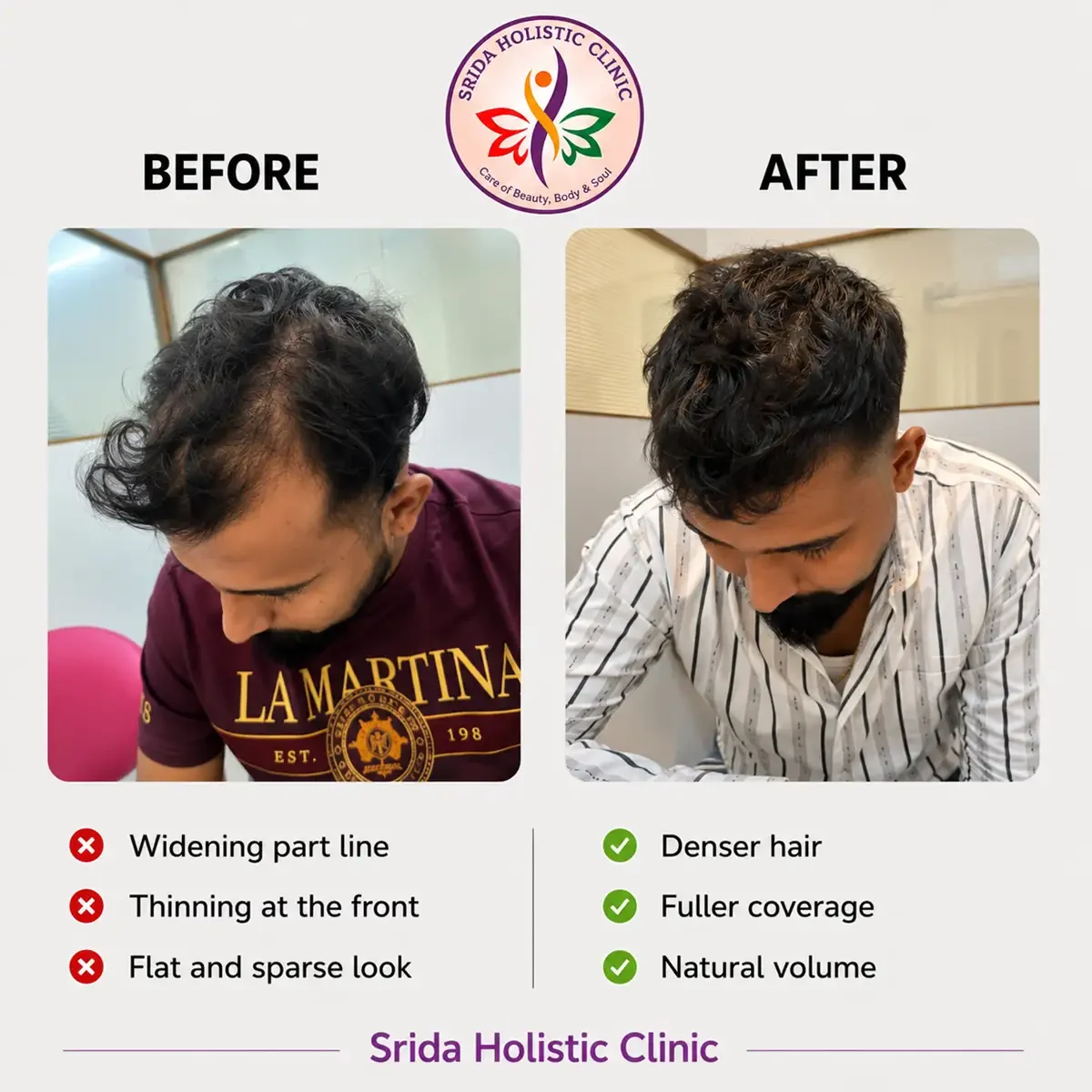 srida-clinic-hair-growth-before-after-results-2
