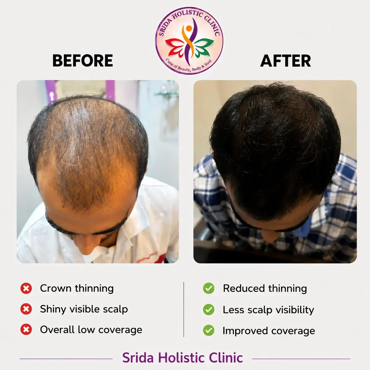 srida-clinic-hair-growth-before-after-results-3