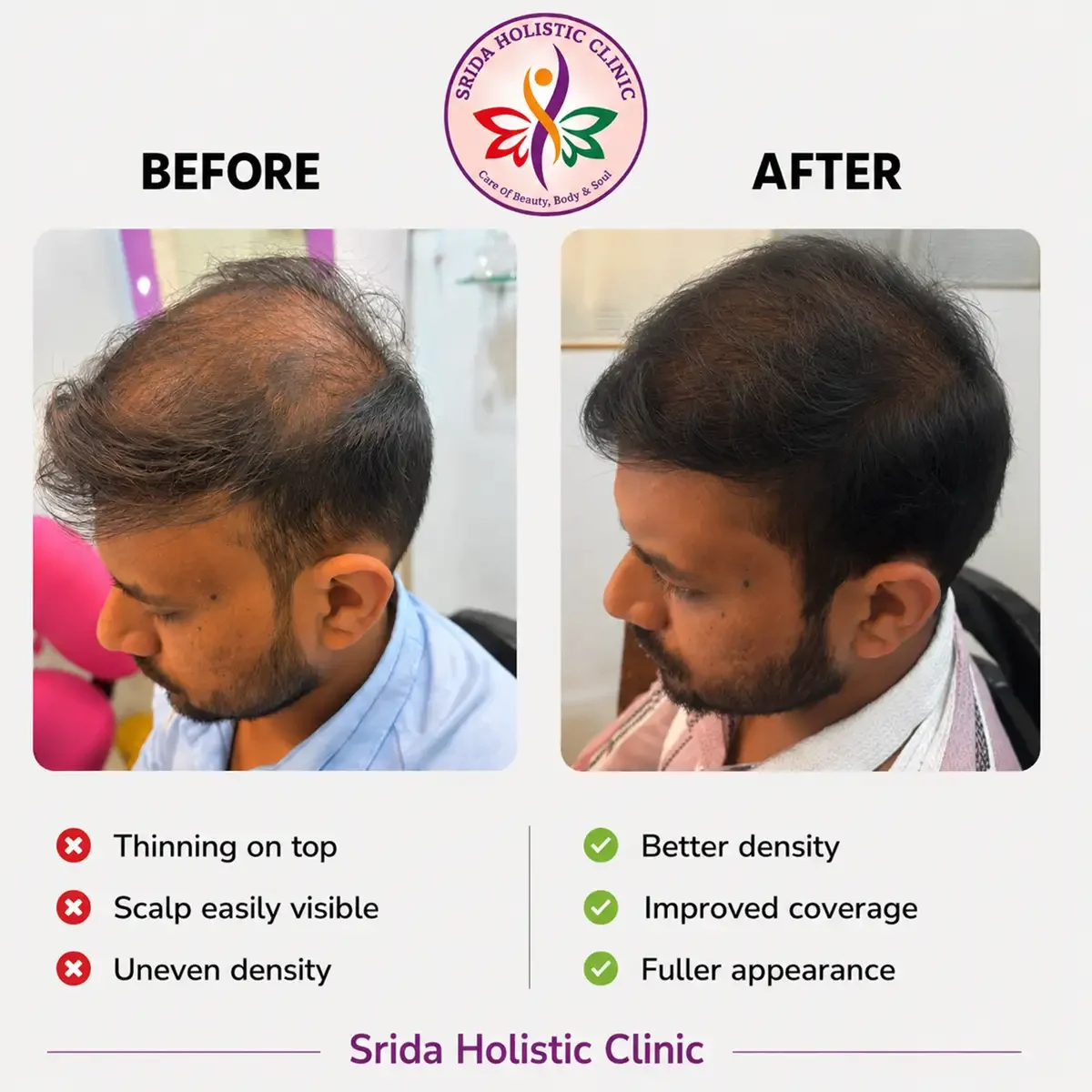 srida-clinic-hair-growth-before-after-results-4
