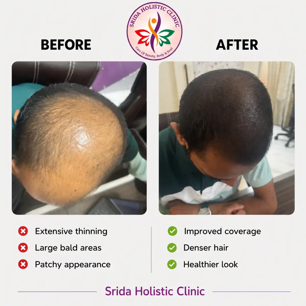 srida-clinic-hair-growth-before-after-results-5