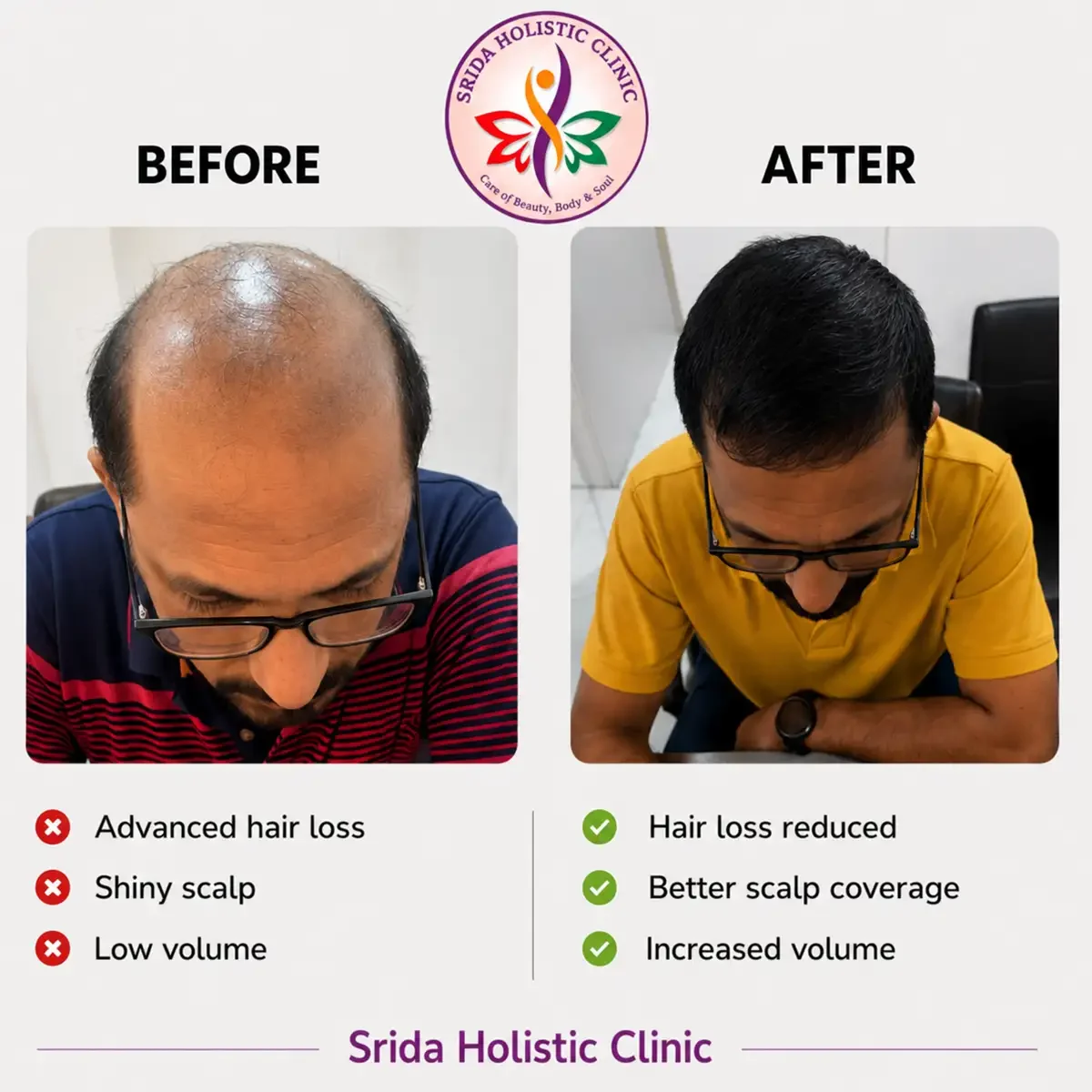 srida-clinic-hair-growth-before-after-results-7