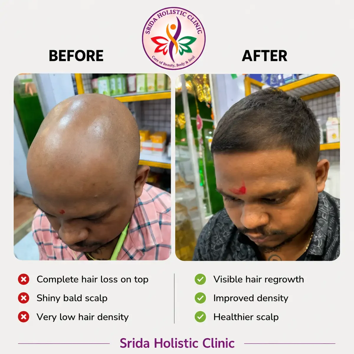 srida-clinic-hair-growth-before-after-results-8