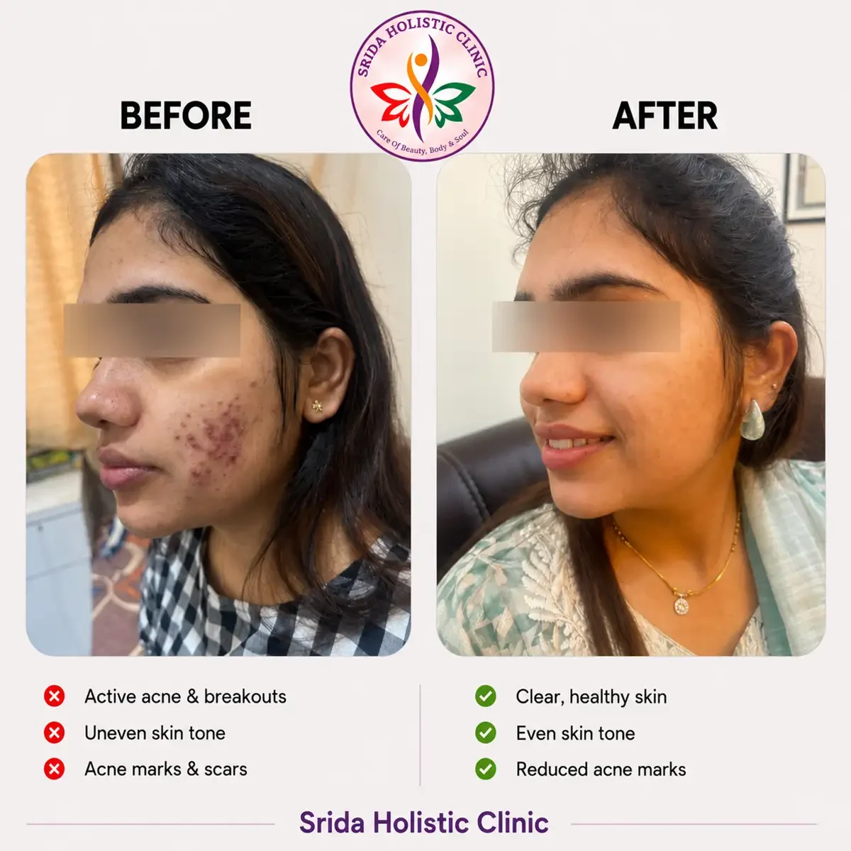 srida-clinic-skin-acne-before-after-results-3