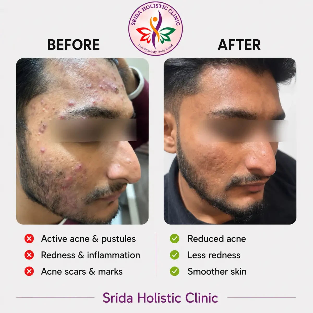 srida-clinic-skin-acne-before-after-results-4