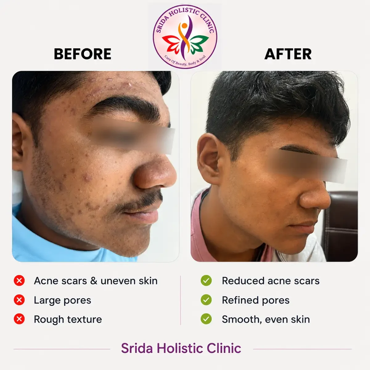 srida-clinic-skin-acne-before-after-results-5