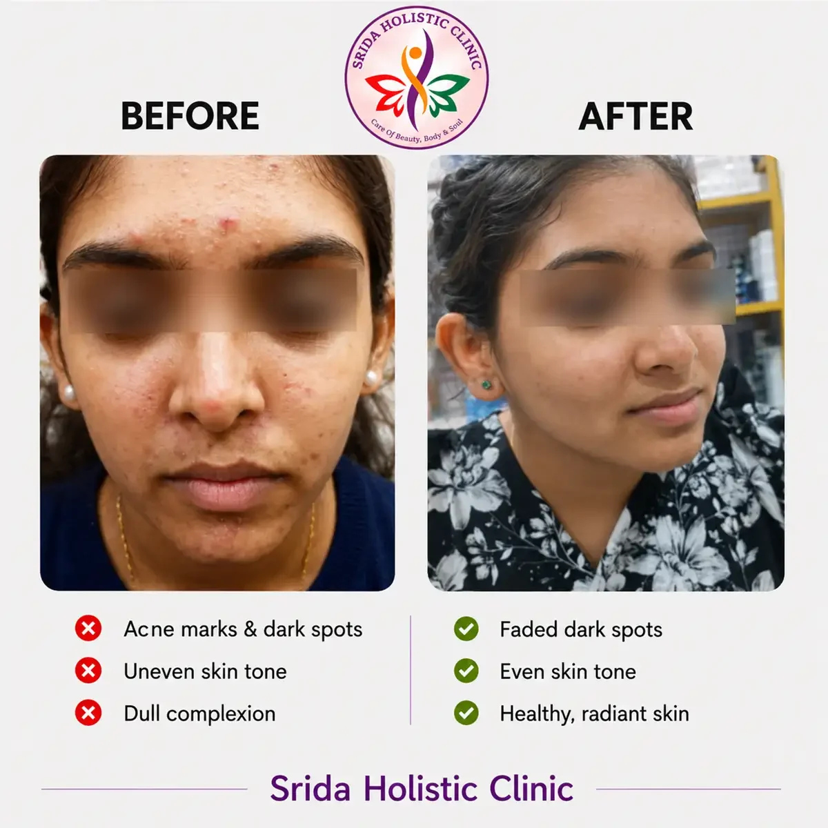 srida-clinic-skin-acne-before-after-results-6