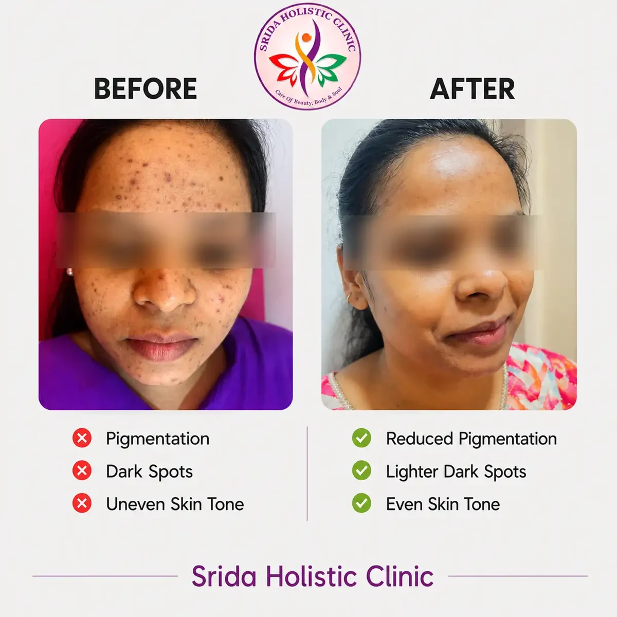 srida-clinic-skin-pigmentation-before-after-results-1