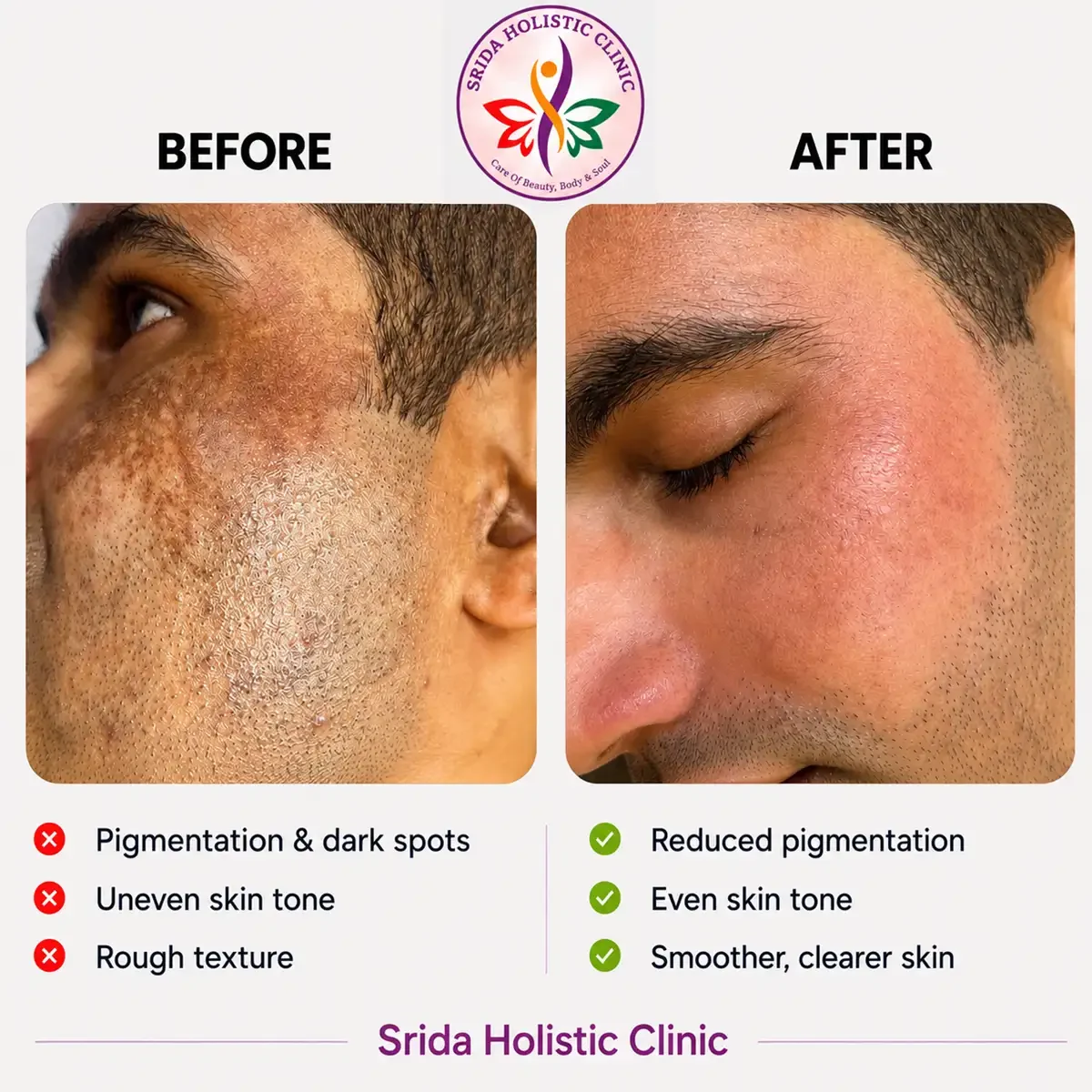 srida-clinic-skin-pigmentation-before-after-results-2